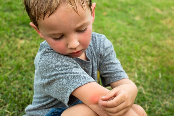 Insect Bite Relief